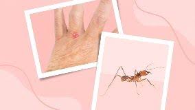 Image result for ant bite