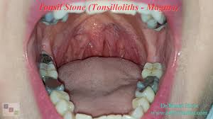 Image result for Tonsillolith