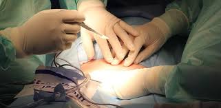 In ce priveste lista de asteptare pe transplant hepatic la nivelul institutului de boli digestive si transplant. Transplantul De Ficat Totul Despre Transplant Sfaturimedicale Ro