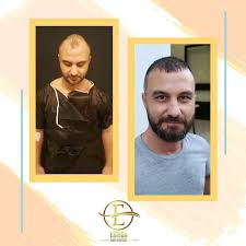 Dhi Sac Ekimi Esteda Hair Hospital