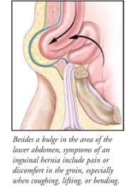 Some causes of a groin strain the human body groin area. Inguinal Hernia