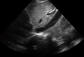 Inferior Vena Cava Ultrasound Radiology Case Radiopaedia Org