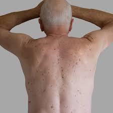 Image result for Solar Lentigo