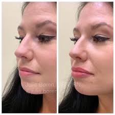 Before and After Lip Filler by @julie.boren 💉