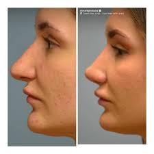 My experience with Dr Anthony Corrado. Afters are with my new doctor. :  r/PlasticSurgery