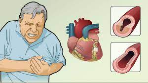 Unstable Angina Information Mount Sinai New York