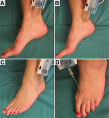 Image result for Compartment Syndrome
