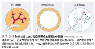 Check spelling or type a new query. è‚ºçµæ ¸ç—‡ã¨ã¯ ã‚³ãƒˆãƒãƒ³ã‚¯