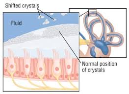 Image result for Acute Labyrinthitis