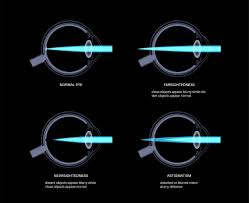 Image result for Refractive Error