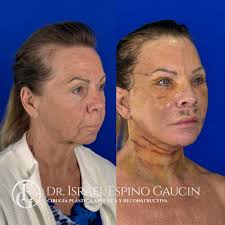 EleganceInEveryStage One of the most important aspects of facial  rejuvenation is seeing the real progress in the early days. Today, I had  the pleasure of seeing my 65-year-old patient