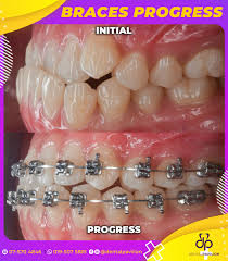 In eleifend vehicula lectus, sed condimentum justo gravida non. Twitter à¤ªà¤° Klinik Gigi Dental Pavilion Potongan Diskaun Untuk Braces Sebanyak Rm1000 Boleh Whatsapp Direct Dekat Https T Co Lc7zao4zwg Atau Call 075704846 Lokasi Klinik Atas Family Mart Taman Universiti Skudai Johor Di