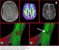 Pin On Tbi