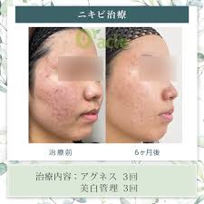 アグネス-最新のニキビ・ニキビ跡治療｜【公式】オラクル美容皮膚科