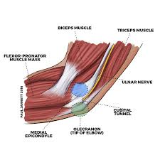 Mr Paul Jarrett Ulnar Neuropathy At The Elbow Cubital Tunnel Syndrome Murdoch Orthopaedic Clinic