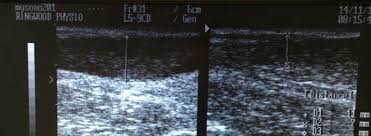 They also may occur in the ankles and feet. What Is That Lump On My Achilles Physica