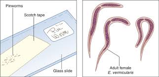 Image result for Pinworm