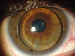 With these simple tips and tricks from contact lens expert dr. A View Of Optimal Piggyback Contact Lens Fitting The Rigid And Soft Download Scientific Diagram