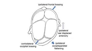 Image result for Positional Head Deformity