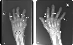 Rheumatoid arthritis is a chronic inflammatory disorder that can affect more than just your joints. Rheumatoid Arthritis Radiology Key