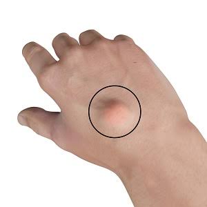 Hand Tumors | Advanced Orthopaedics & Sports Medicine, Orthopaedic  Specialists, Cypress, Houston, TX