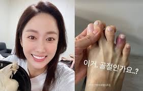 Jeon Hye Bin Reveals Her Bruised Foot Is This A Fracture Newsdir3