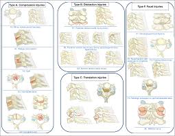 Image result for Subaxial Injury Classification Scale