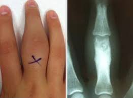 May have been there for years but not noticeable with overweight calves. Osteoid Osteoma Orthoinfo Aaos