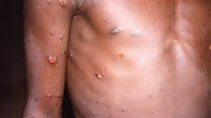 Monkeypox: 80 cases confirmed in 12 countries - BBC News