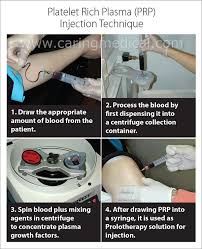 What to consult and see if you are suitable for the skin therapy using prp in malaysia? Platelet Rich Plasma For Knee Osteoarthritis When It Works When It Does Not Work Caring Medical Florida