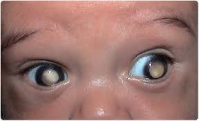 Bacteria are connected to how babies experience fear memory details fade over time, with only the main gist preserved. Eye Disease In Infants Detected Using Smartphone App