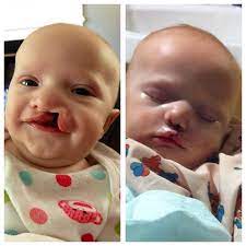 After a child has had surgery to close a cleft lip and/or palate, his or her parents may be concerned about how to look after him or her properly. Cleft Lip Before After Surgery Cleft Lip Cleft Lip And Palate Cleft Palate