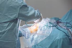 Arthroscopic Surgery Ineffective For Knee Catching Locking