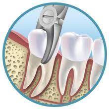 Uh Oh Doom And Bloom Tm Tooth Extraction Dental Extraction Tooth Extraction Aftercare