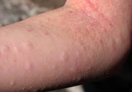 Sunscreen, also known as sunblock or suntan lotion, is a lotion, spray, gel, foam (such as an expanded foam lotion or whipped lotion). Sunscreen Allergy