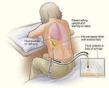 Pleurisy Wikipedia