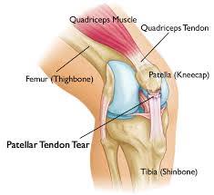 The pain may increase over a period of time, depending on the physical activity of the person. Patellar Tendon Rupture Treatment Surgery And Rehabilitation Sportsmd