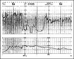 Litigation Electronic Fetal Monitoring And The Obstetric