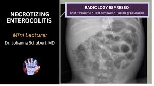 Image result for Necrotizing Enterocolitis