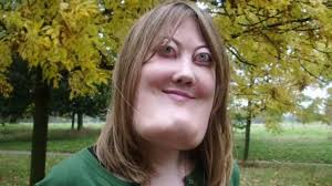 Habías oído hablar del querubismo? El querubismo es una condición médica  rara que afecta el desarrollo de los huesos de la cara, particularmente los  maxilares. Se caracteriza por una hinchazón bilateral de