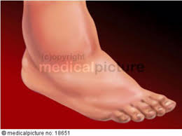 Patients may experience fractures and dislocations of bones and joints with minimal or no known trauma. Diabetic Foot Syndrome Charcot Foot Doccheck