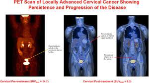 Check spelling or type a new query. Positron Emission Tomography Scan Of Locally Advanced Cervix Cancer Download Scientific Diagram