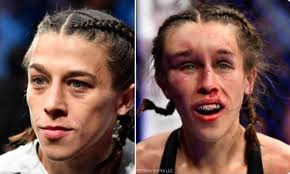 As we mentioned earlier in the article; Incredible Before And After Pictures Show Battered And Bruised Ufc Fighters Horrific Facial Injuries Daily Mail Online