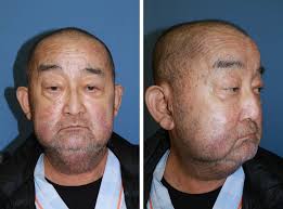 Lymphaticovenular Anastomosis for Persistent Immunosuppressant-Related  Eyelid Edema