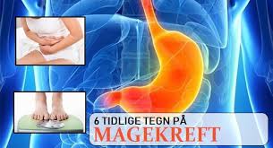 Blodmangel (lav blodprosent og/eller lave jernlagre) kommer av at svulsten ofte har blødd inn i tarmen over tid. 6 Tidlige Tegn Pa Magekreft Symptomer Funn Og Kliniske Tegn