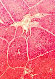 When symptoms do appear, they can mimic the signs of other diseases and conditions, making it. Primary Liver Tumours Presentation Diagnosis And Surgical Treatment Intechopen