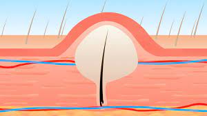Treating And Preventing Ingrown Pubic Hair: What To Avoid