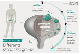 La paroi interne de la vessie est tapissée de cellules transitionnelles qui sont à l'origine de la plupart des cancers de la vessie. Cancer De La Vessie Le Tabac Gros Facteur De Risque