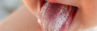 Image result for oral thrush symptoms roof of the mouth