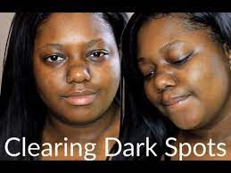 Immediately, you should notice that your skin looks smoother and more moisturized. Cocoa Butter Cleared My Skin How I Cleared My Dark Spots Acne Youtube